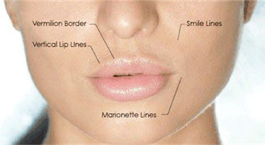 lab spa clinic lip injections  LABSkinClinicNeutralBay / MilitaryRoadNeutralBayNewSouthWales.