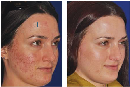 before after lab skin clinic cremorne