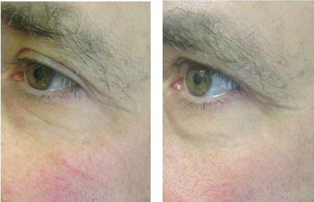 before after wrinkles needling cammeray