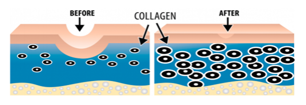 collagen before after cremorne