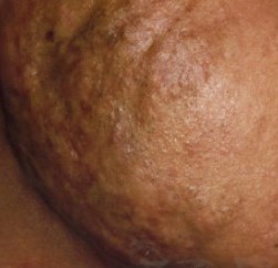 Hypertrophic Keloid acne scars