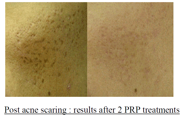 LAB skin clinic before after PRP treatments