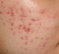 Pigmented Acne Scarring