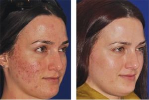 acne scar treatment labskinclinic neutral bay
