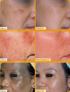 before after laser treatment