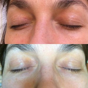 Before After non surgical blepharoplasty