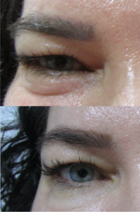 before after eyes