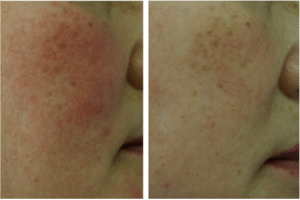 before after rosacea treatment