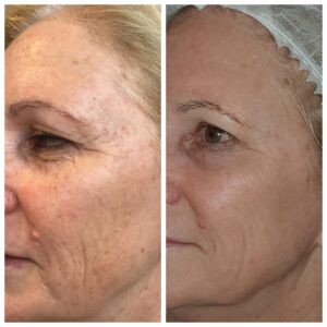 Before After microneedling scaled