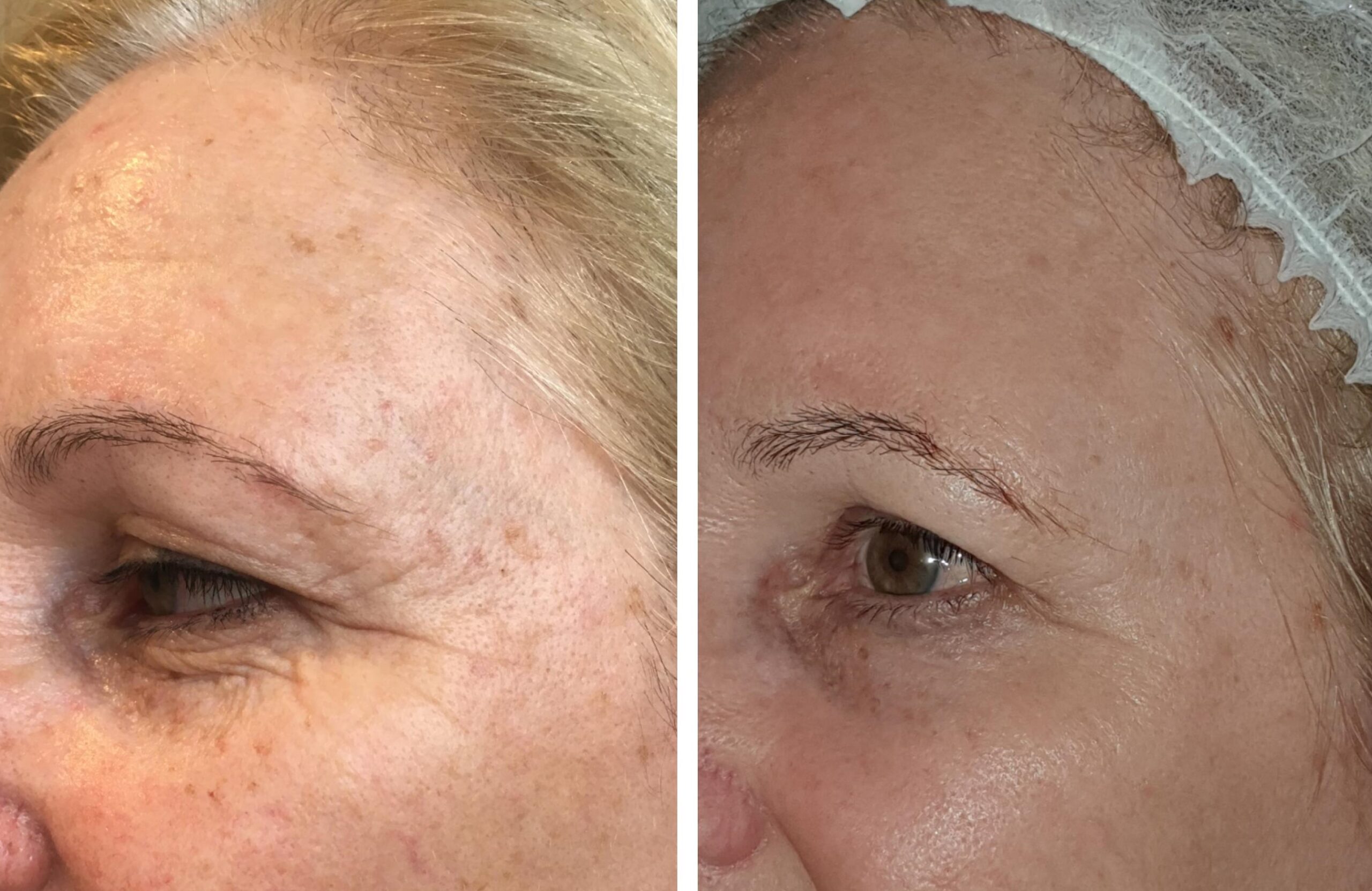 Before After Plasmage eye lift scaled