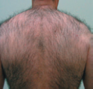 before hair removal male