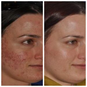 before after skin needling acne scaled