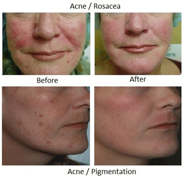 acne pigmentation